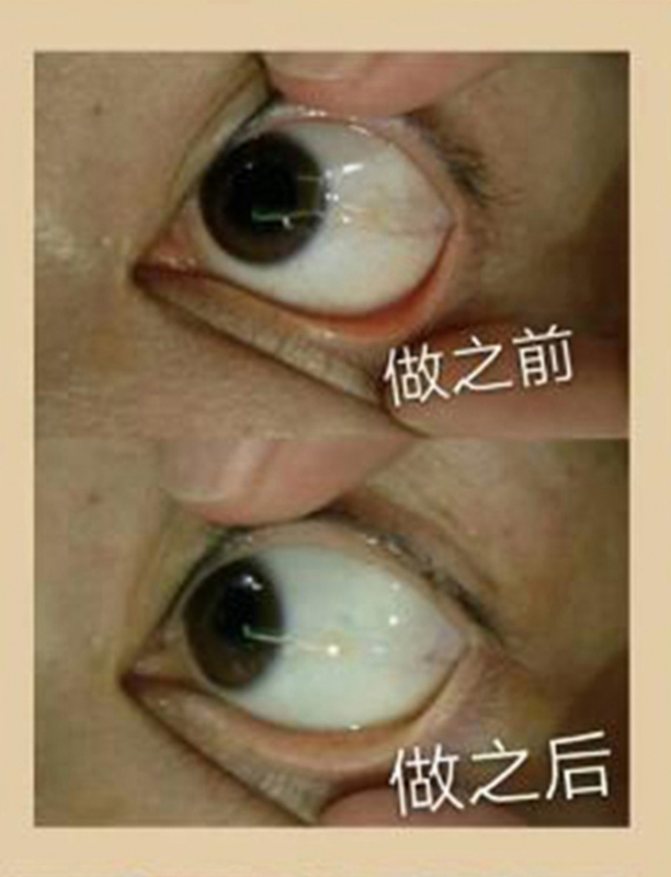 眼球抗衰对比案例